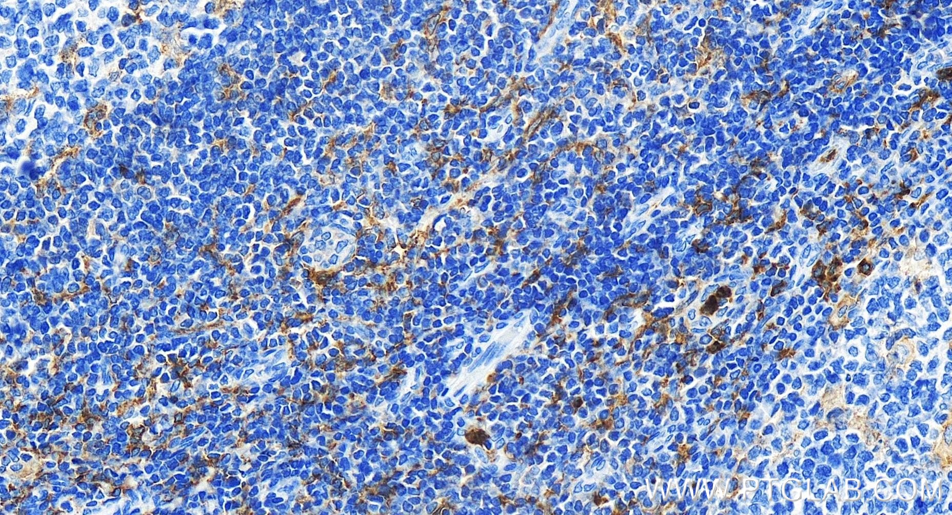 IHC staining of human tonsillitis using 84341-3-RR (same clone as 84341-3-PBS)