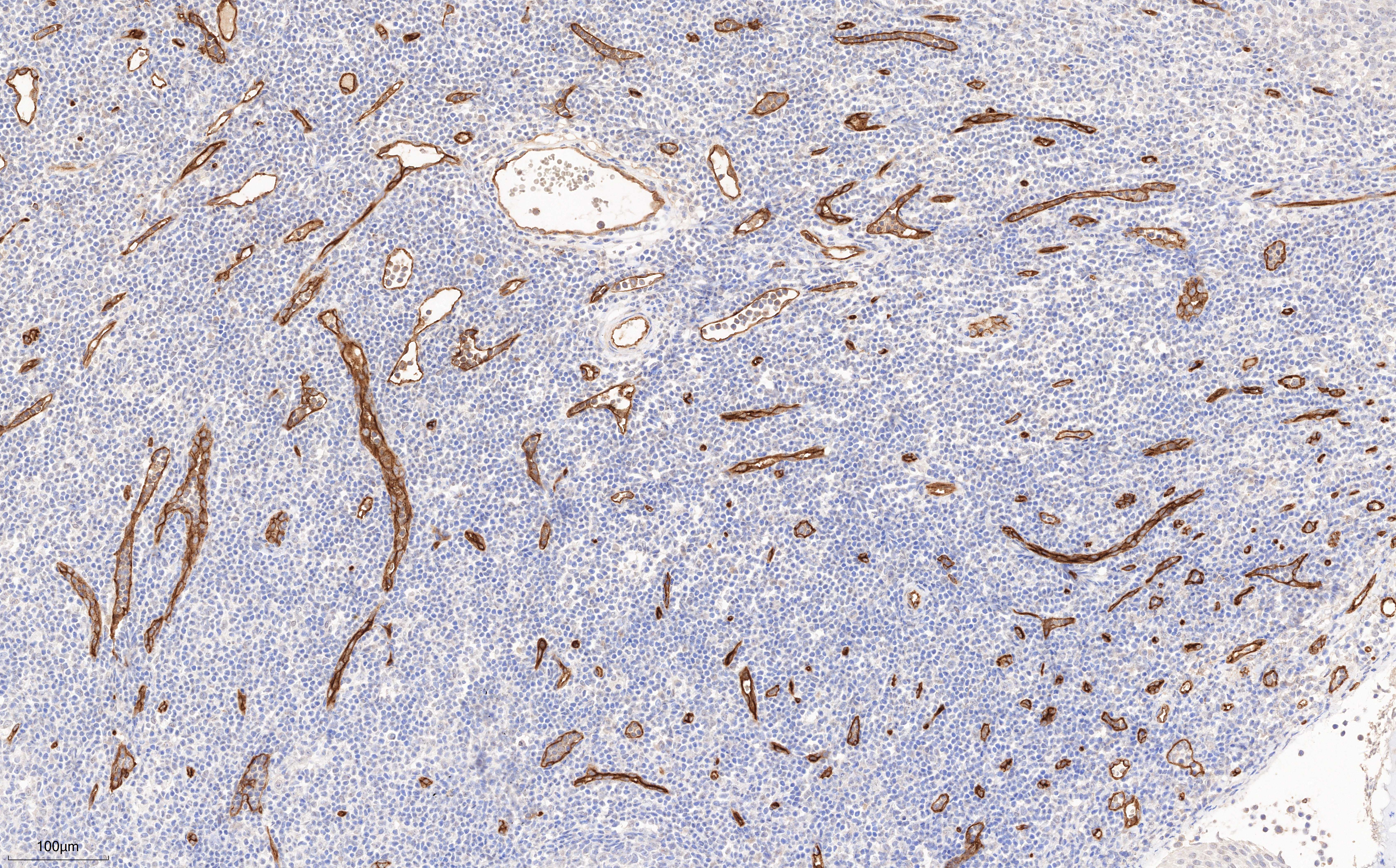 IHC staining of human tonsillitis using 60180-2-Ig (same clone as 60180-2-PBS)