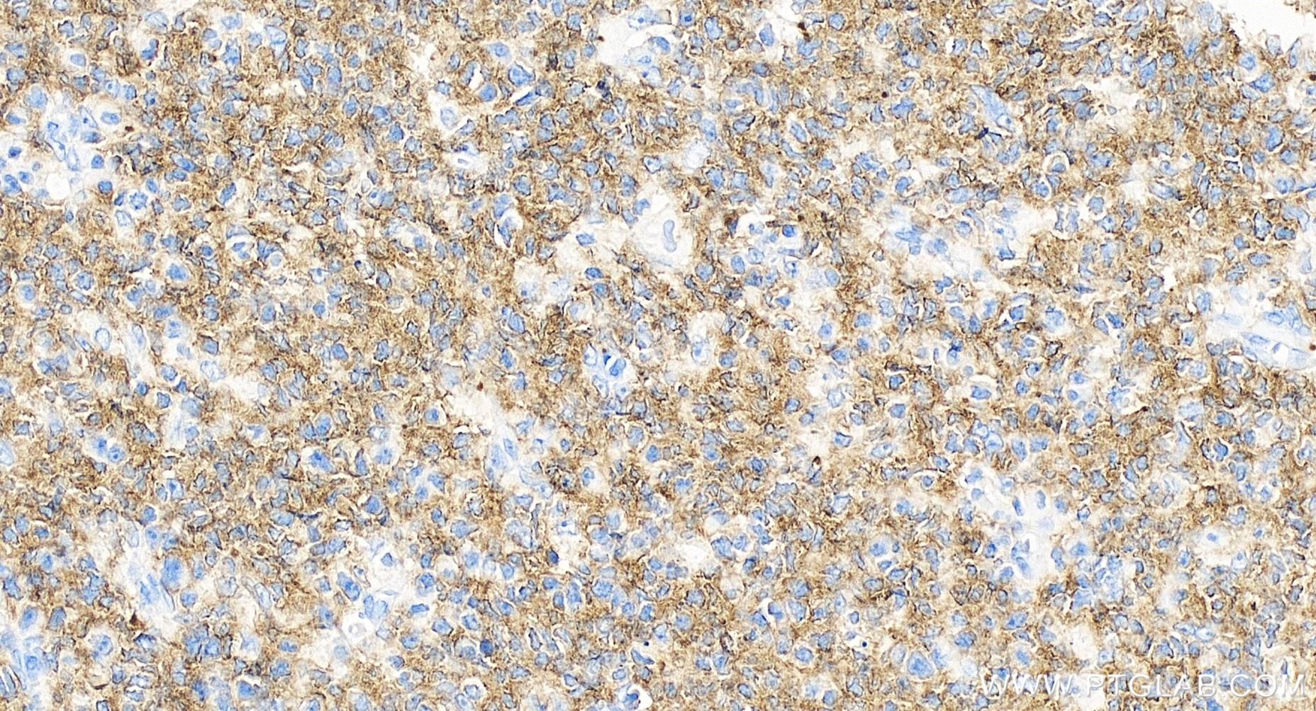 IHC staining of human tonsillitis using 84509-2-RR