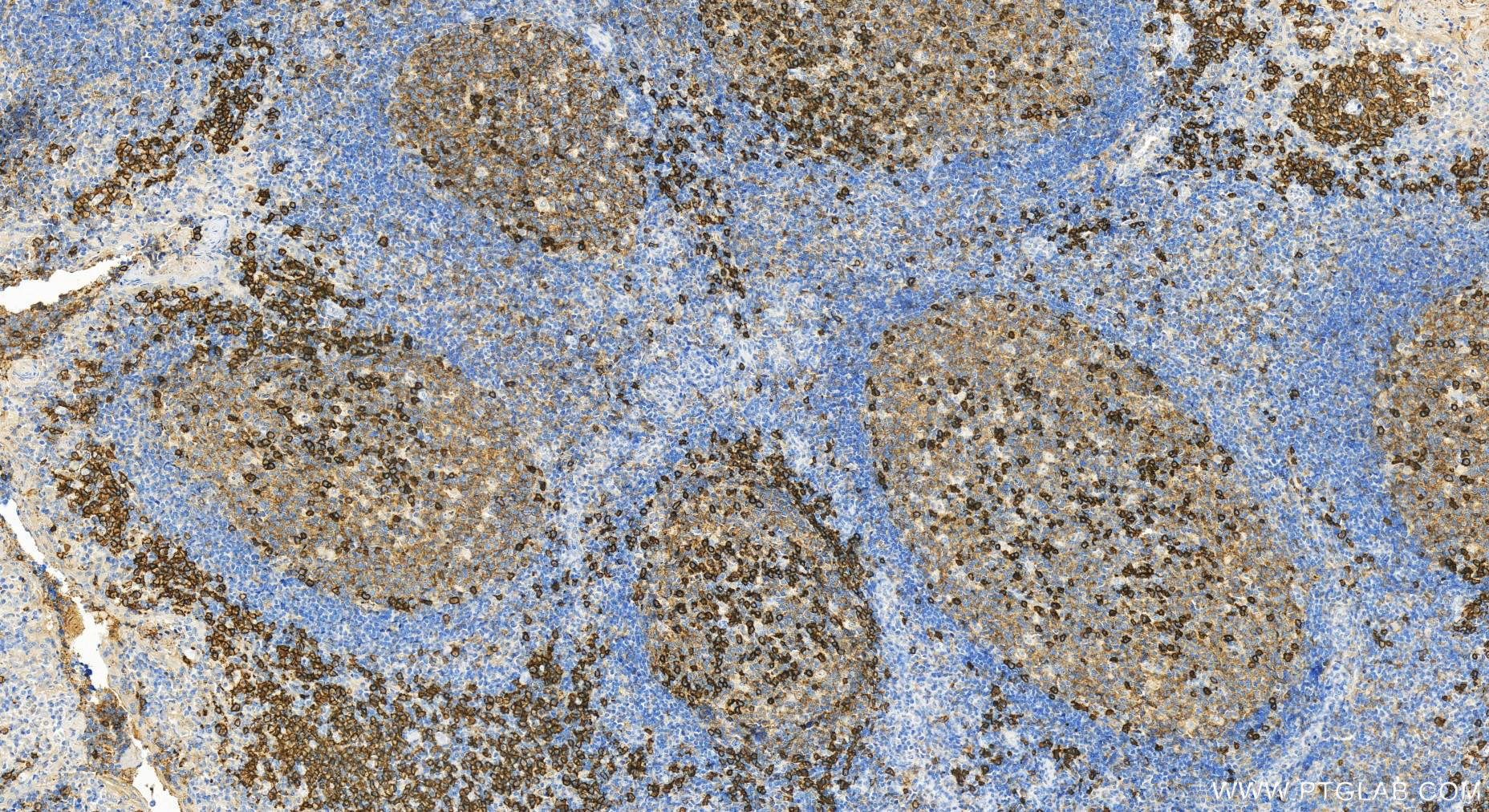 IHC staining of human tonsillitis using 31891-1-AP