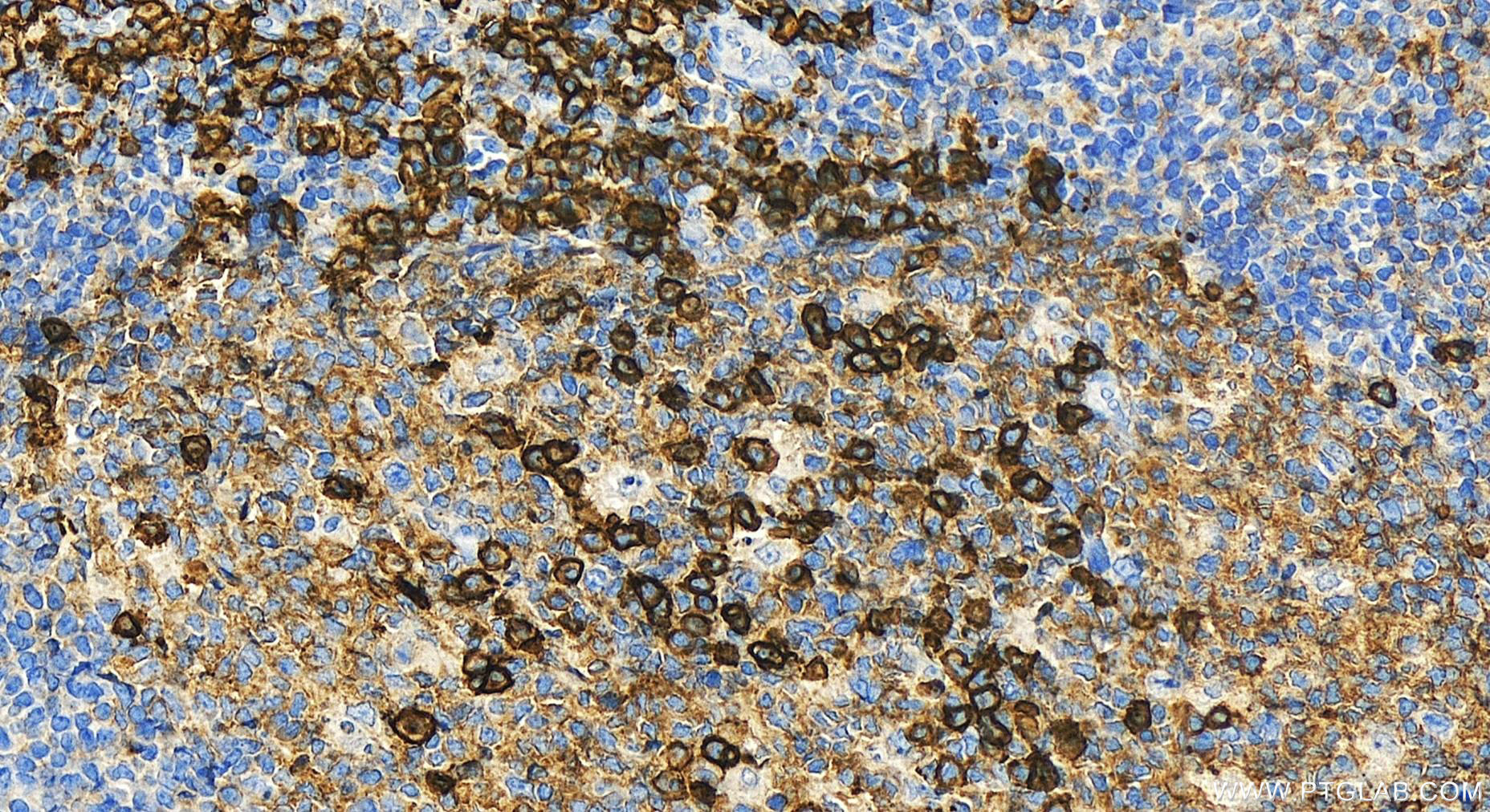 IHC staining of human tonsillitis using 31891-1-AP