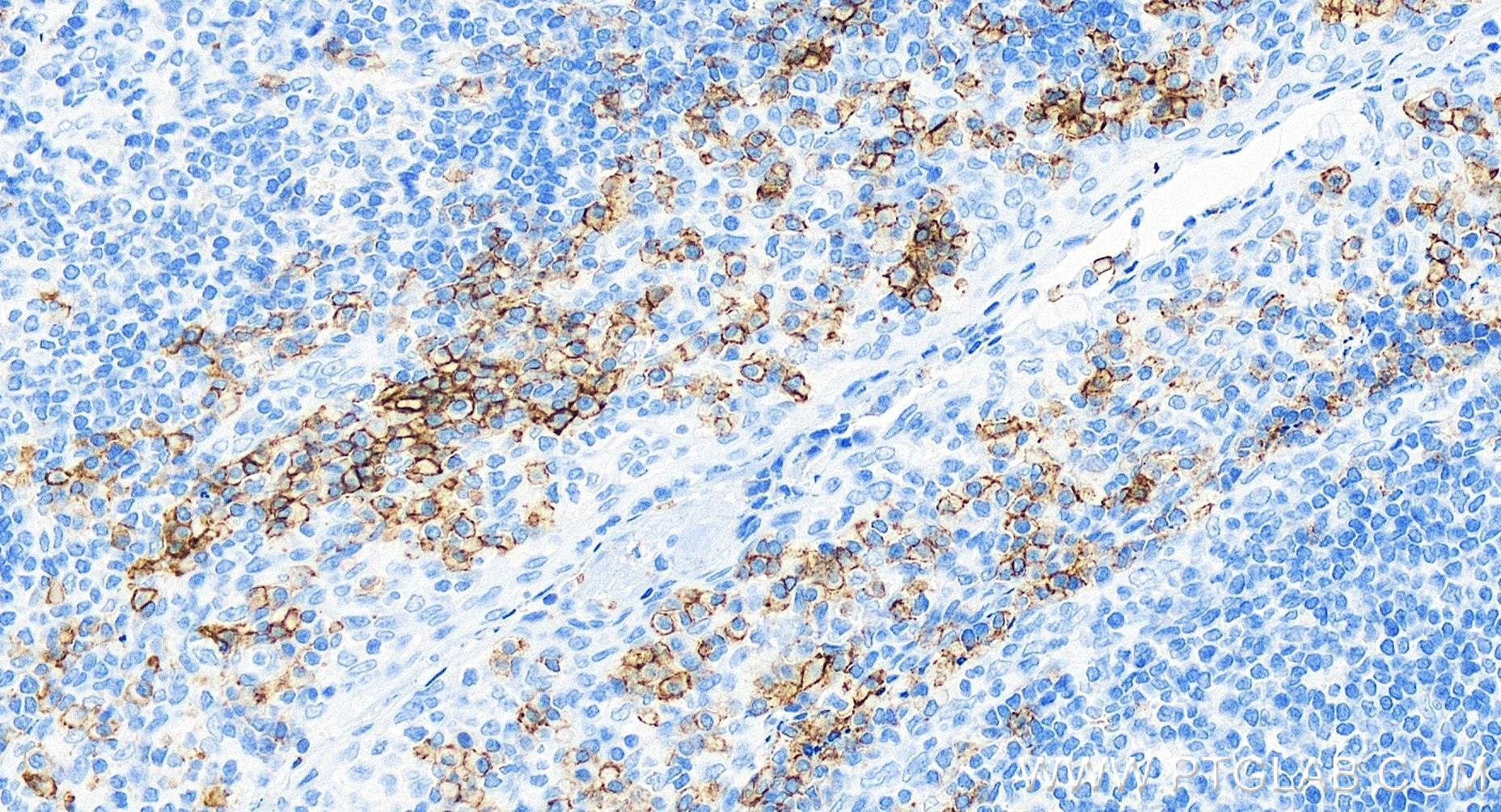 IHC staining of human tonsillitis using 84070-2-RR