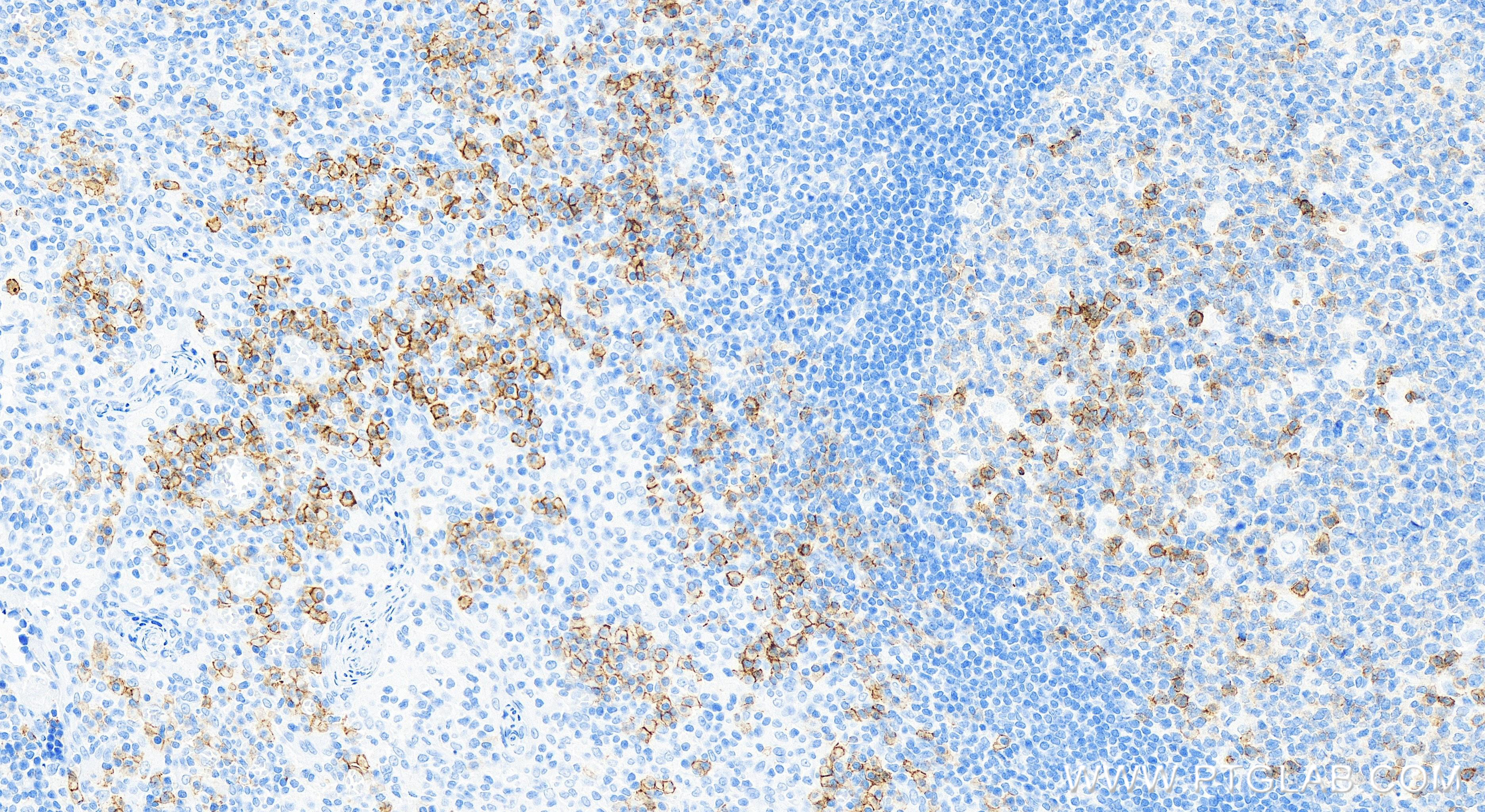 IHC staining of human tonsillitis using 84070-2-RR (same clone as 84070-2-PBS)