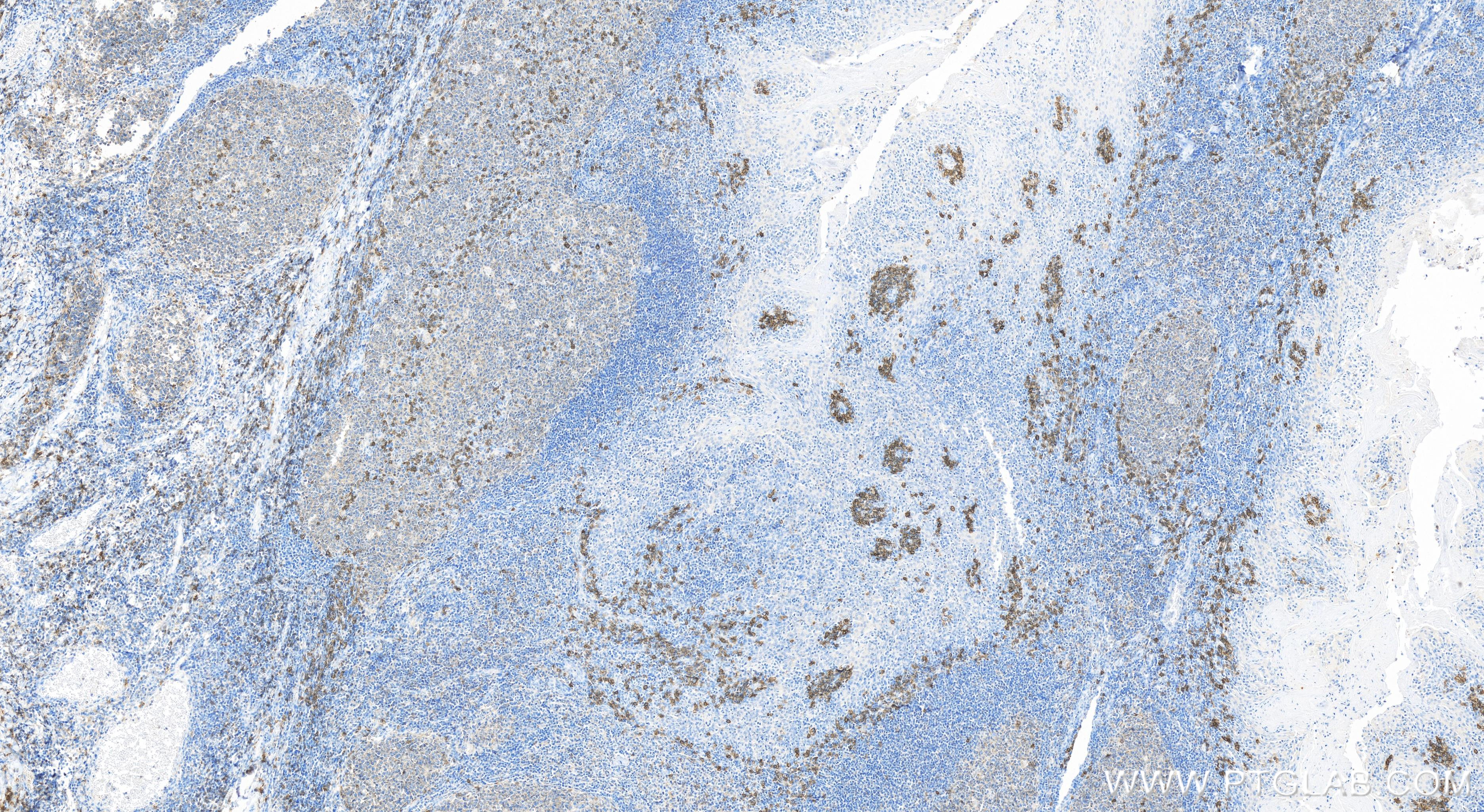 IHC staining of human tonsillitis using 84070-3-RR (same clone as 84070-3-PBS)