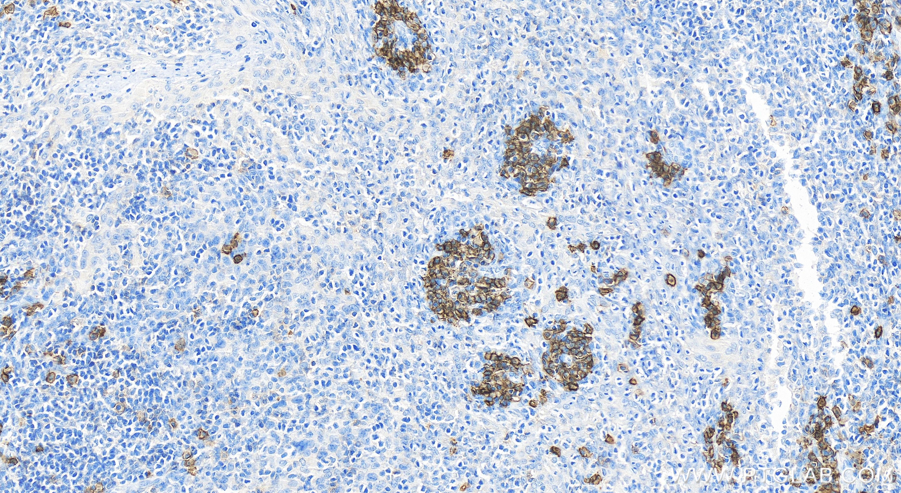 IHC staining of human tonsillitis using 84070-3-RR (same clone as 84070-3-PBS)