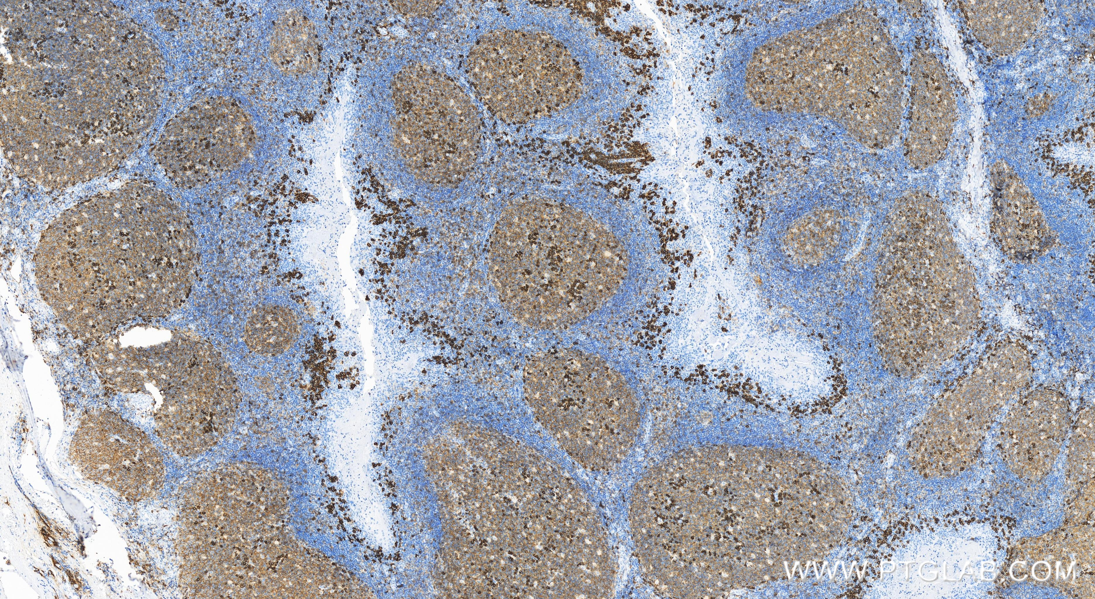 IHC staining of human tonsillitis using 84070-6-RR (same clone as 84070-6-PBS)