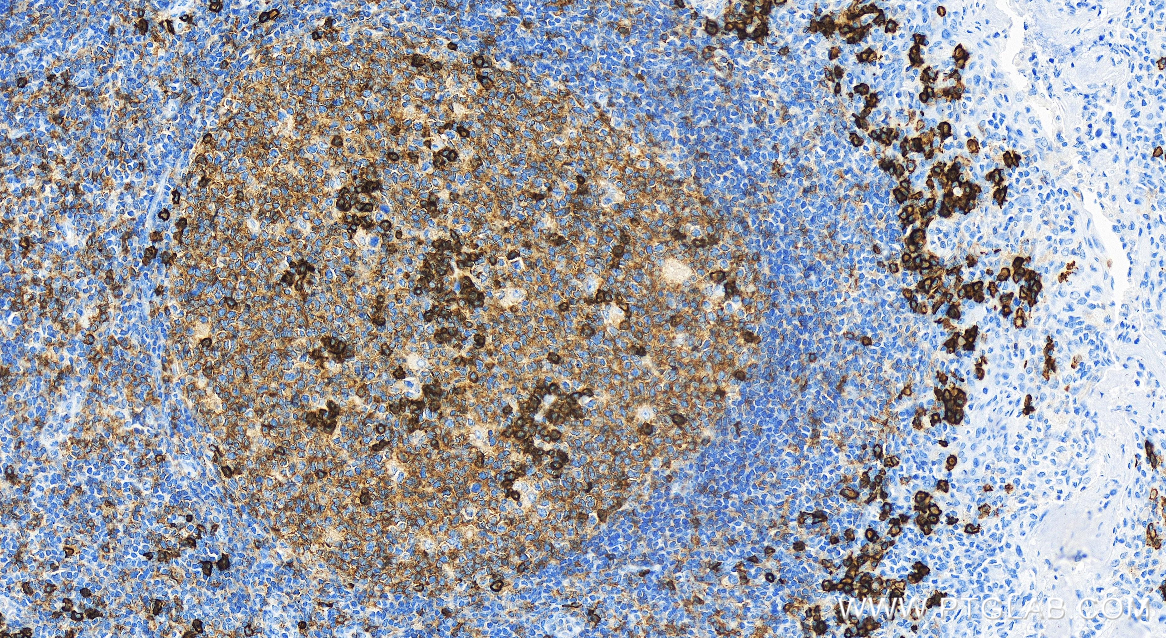 IHC staining of human tonsillitis using 84070-6-RR (same clone as 84070-6-PBS)