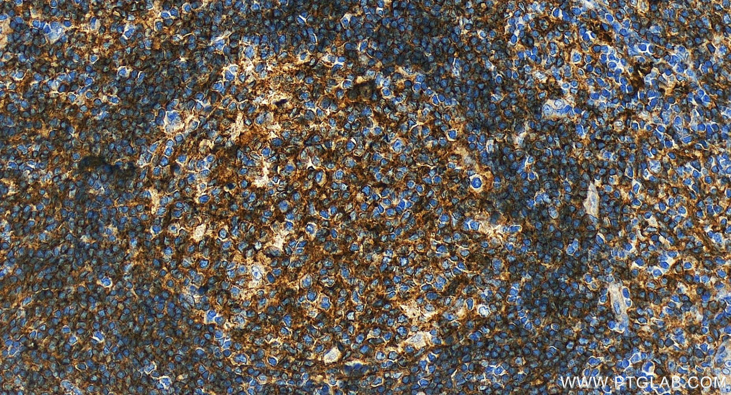 IHC staining of human tonsillitis using 28158-1-AP