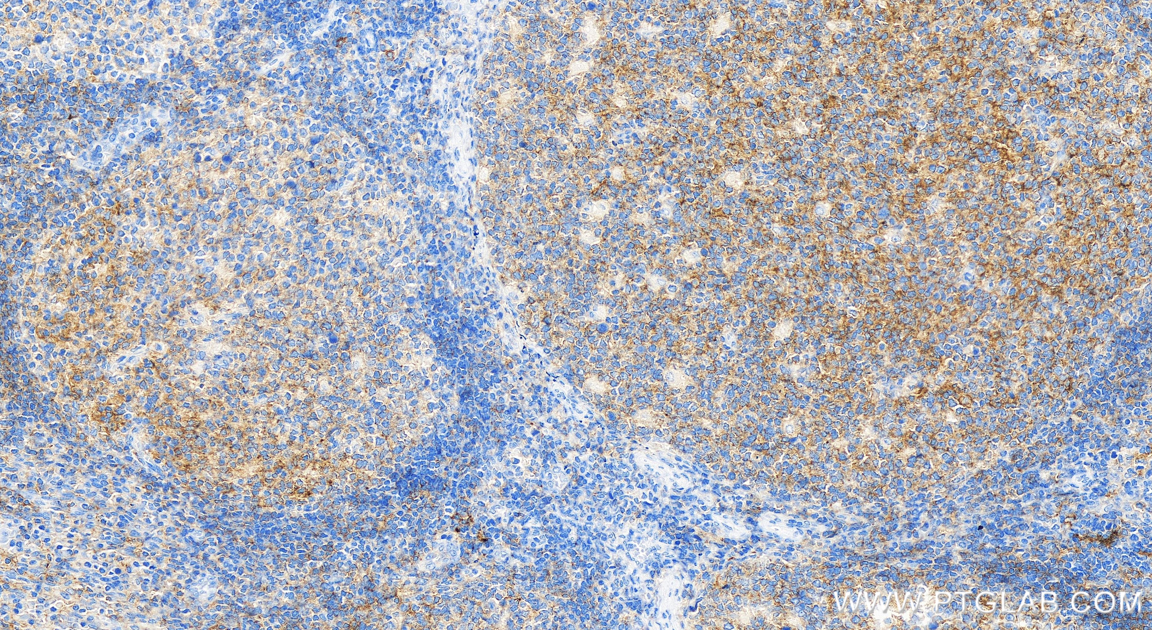 IHC staining of human tonsillitis using 84406-1-RR (same clone as 84406-1-PBS)