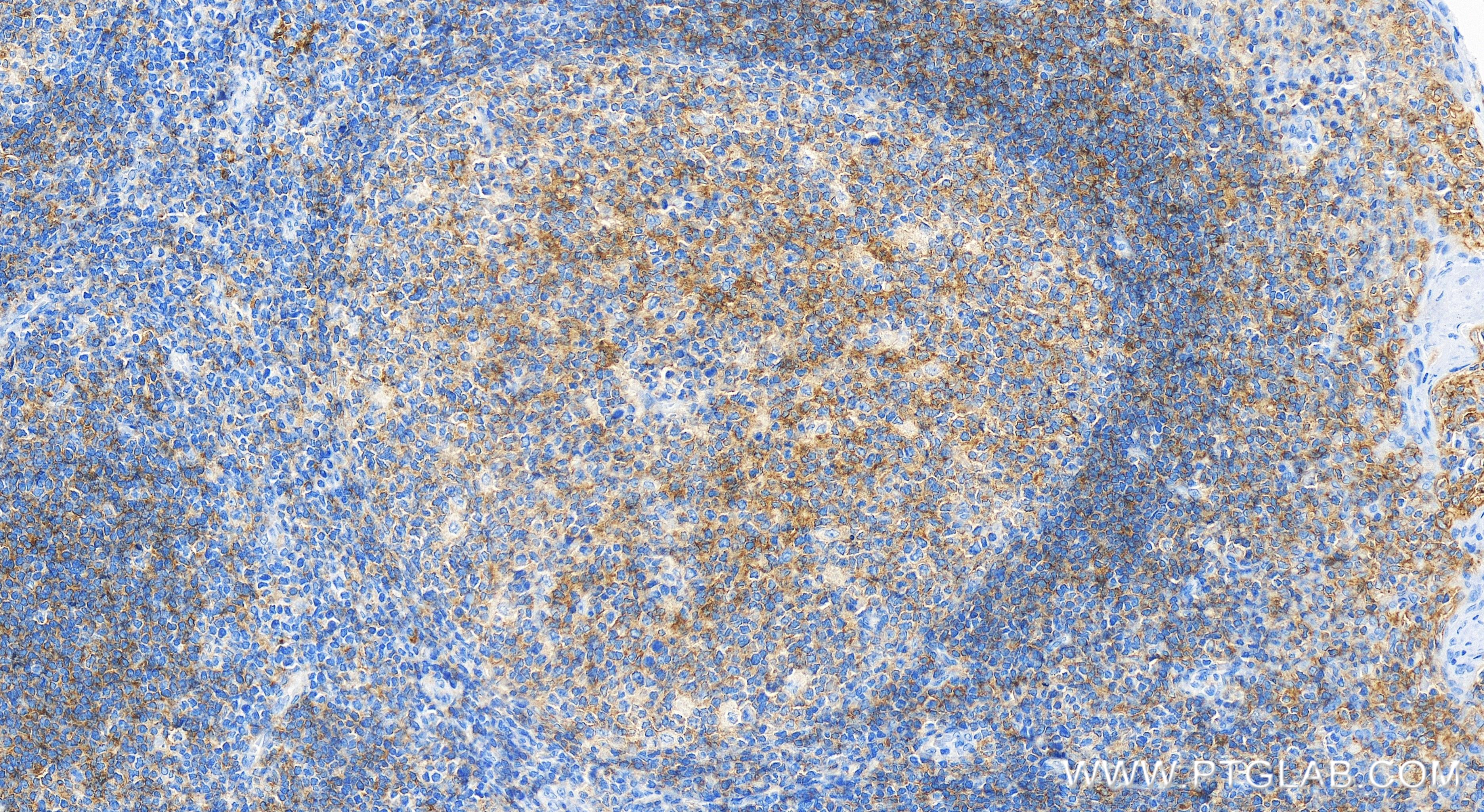 IHC staining of human tonsillitis using 84406-1-RR (same clone as 84406-1-PBS)