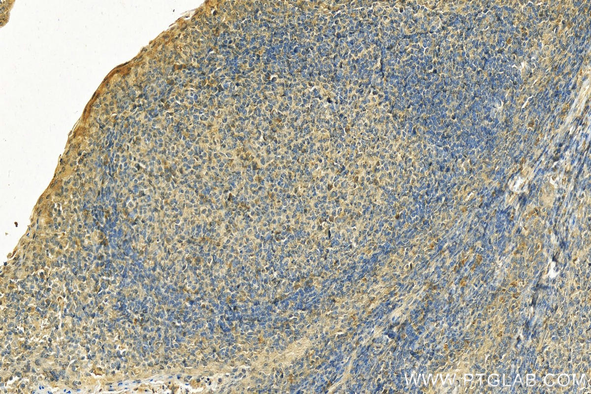 IHC staining of human tonsillitis using 16668-1-AP