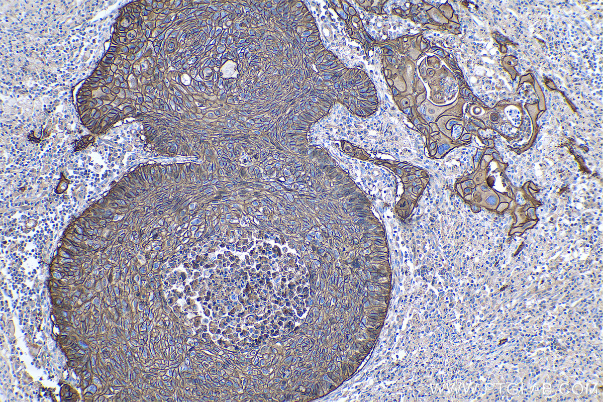 IHC staining of human lung cancer using 60224-1-Ig