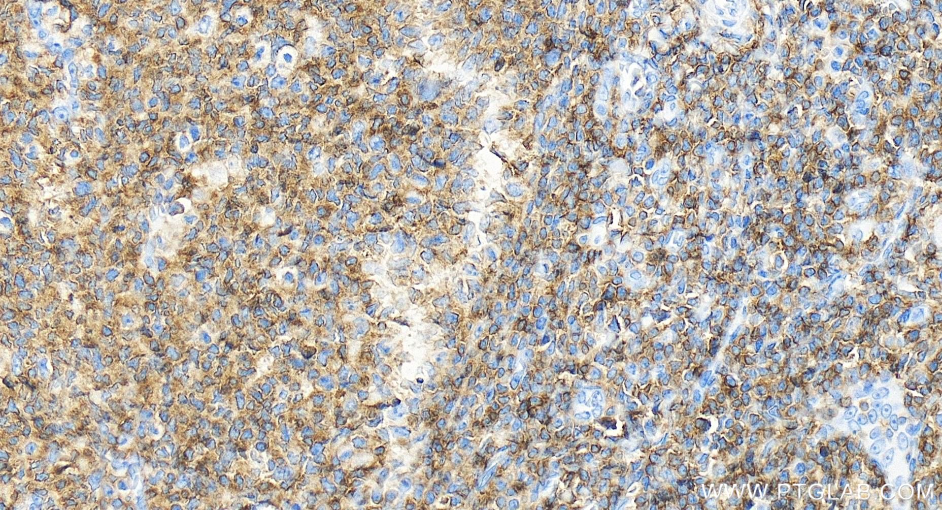 IHC staining of human tonsillitis using 84405-6-RR (same clone as 84405-6-PBS)