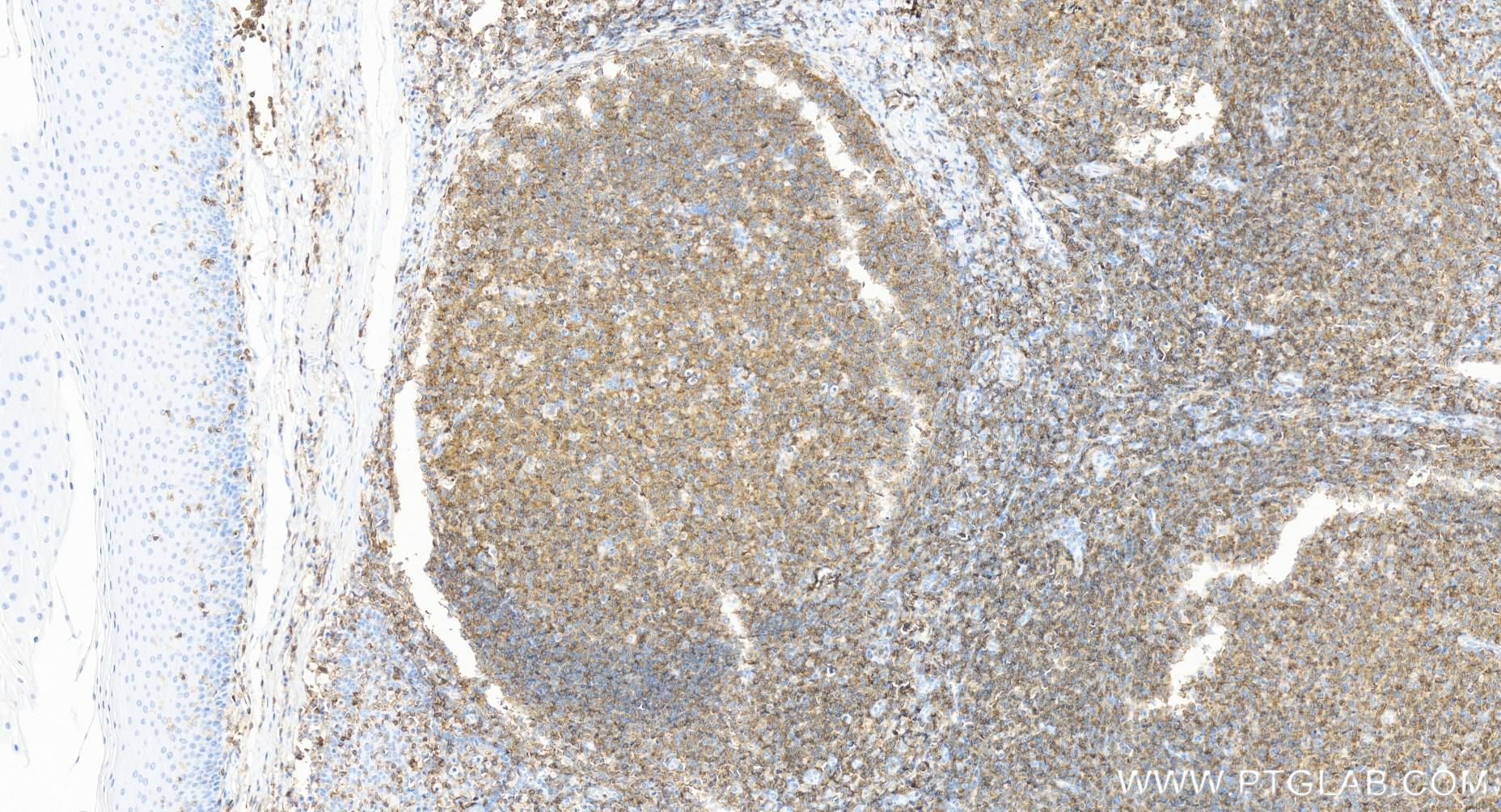 IHC staining of human tonsillitis using 84405-6-RR (same clone as 84405-6-PBS)