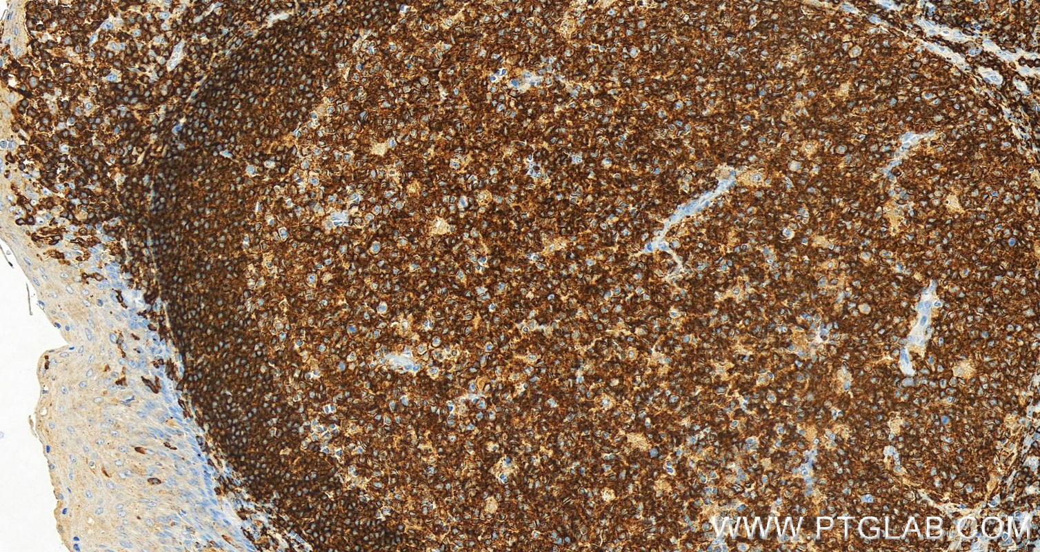 IHC staining of human tonsillitis using 65226-1-Ig