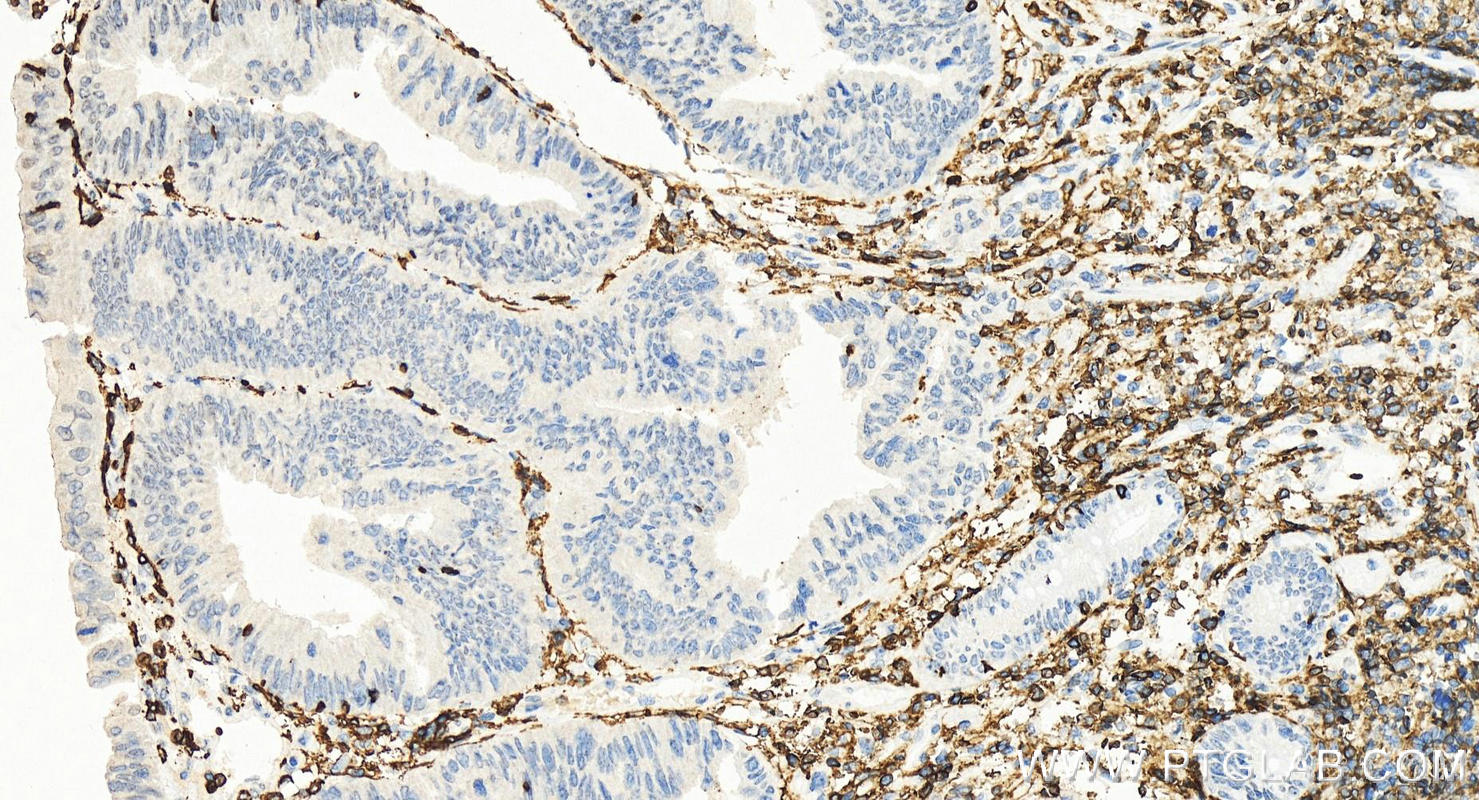 IHC staining of human colon cancer using 65150-1-Ig