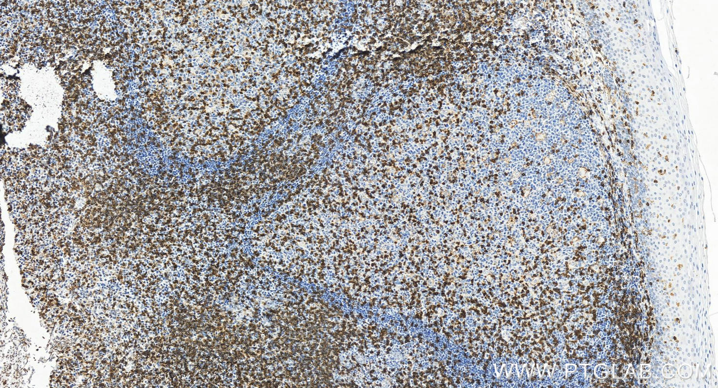 IHC staining of human tonsillitis using 65150-1-Ig (same clone as 65150-1-PBS)