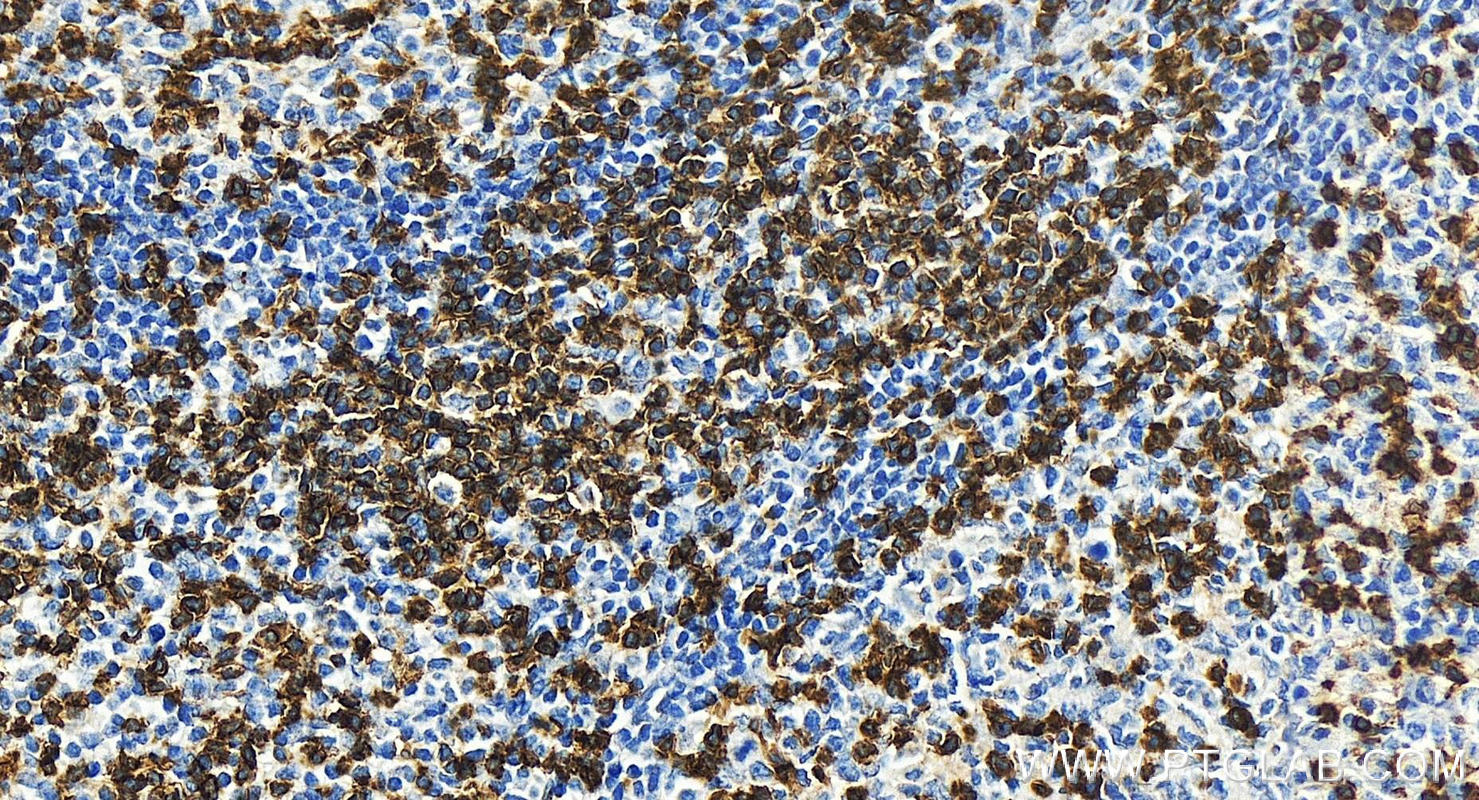 IHC staining of human tonsillitis using 65150-1-Ig