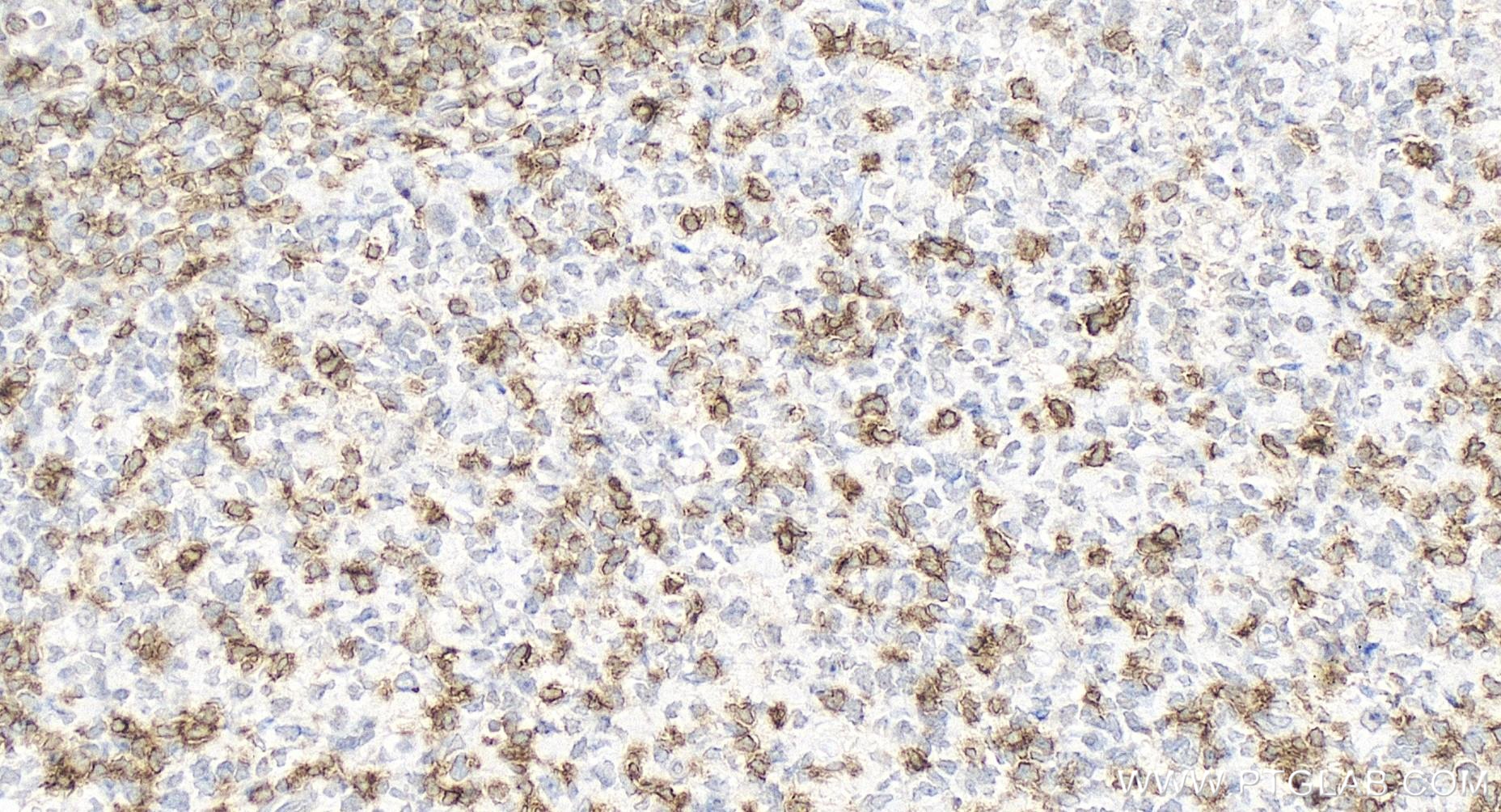 IHC staining of human tonsillitis using 65613-1-MR (same clone as 65613-1-PBS)