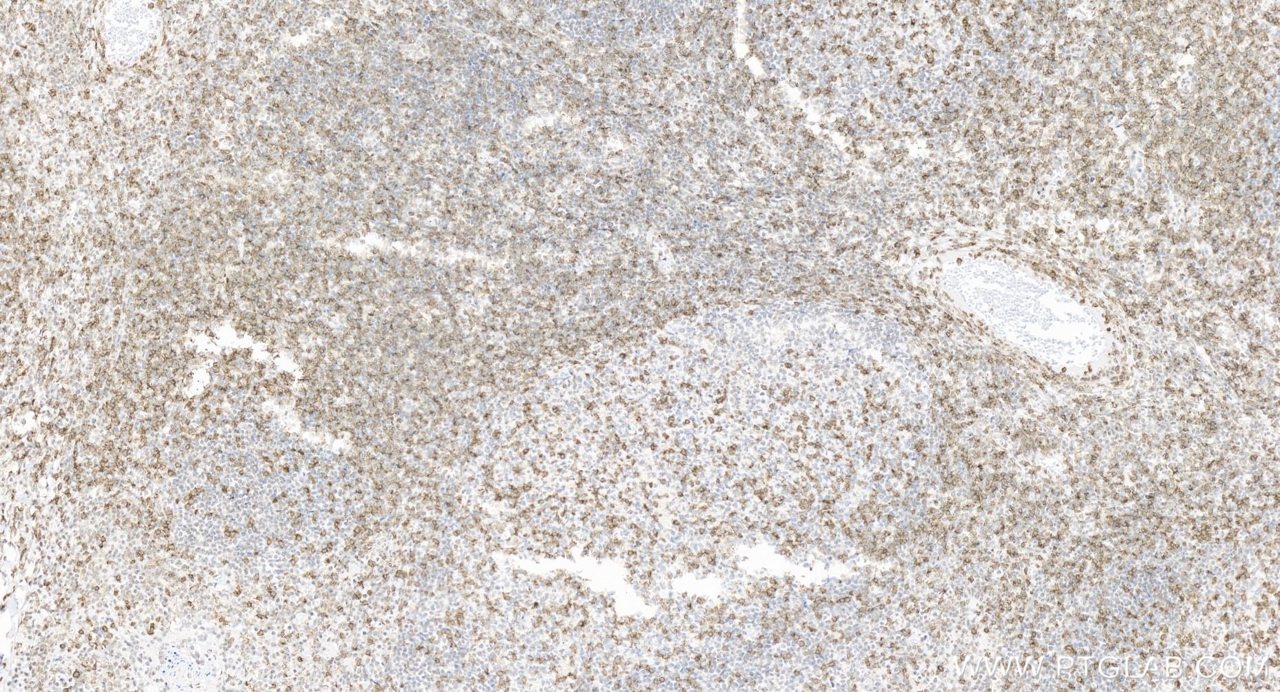 IHC staining of human tonsillitis using 65613-1-MR (same clone as 65613-1-PBS)