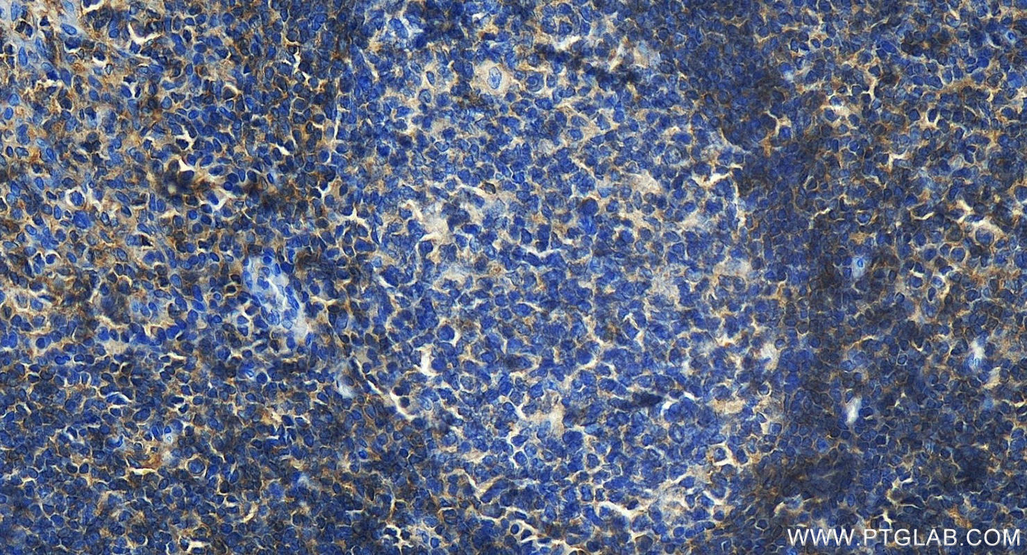 IHC staining of human tonsillitis using 27519-1-AP