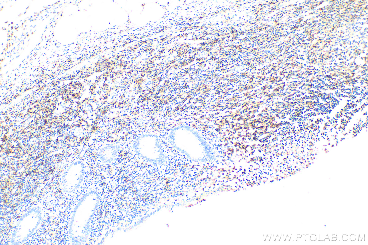 IHC staining of human appendicitis using 31502-1-AP (same clone as 31502-1-PBS)