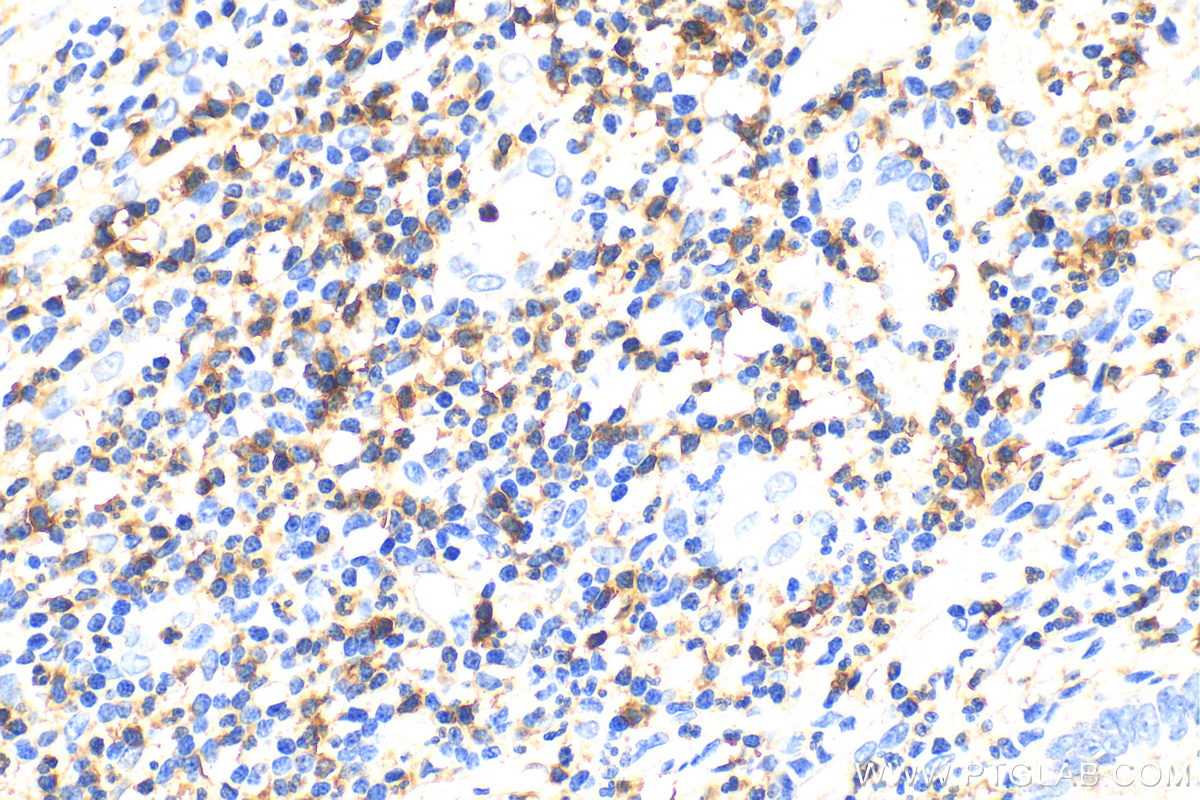 IHC staining of human appendicitis using 31502-1-AP (same clone as 31502-1-PBS)