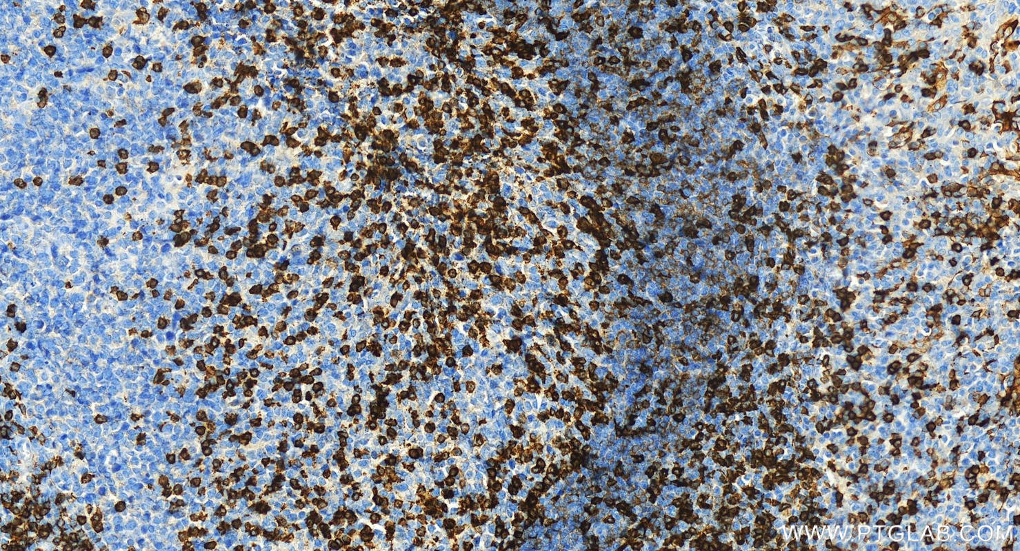 IHC staining of human tonsillitis using 83543-7-RR