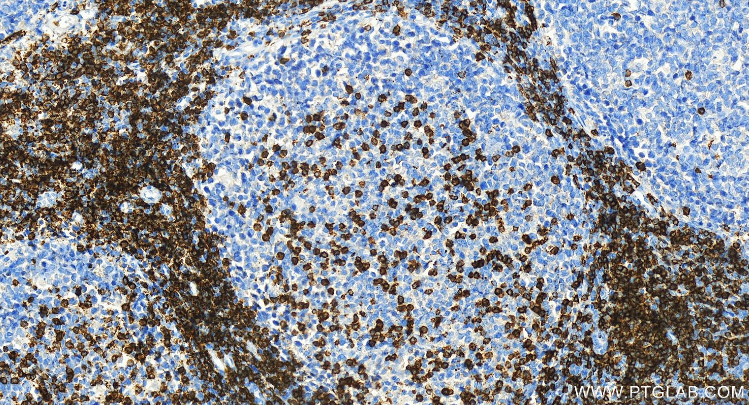 IHC staining of human tonsillitis using 83543-7-RR