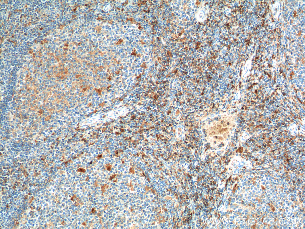 IHC staining of human tonsillitis using 21809-1-AP