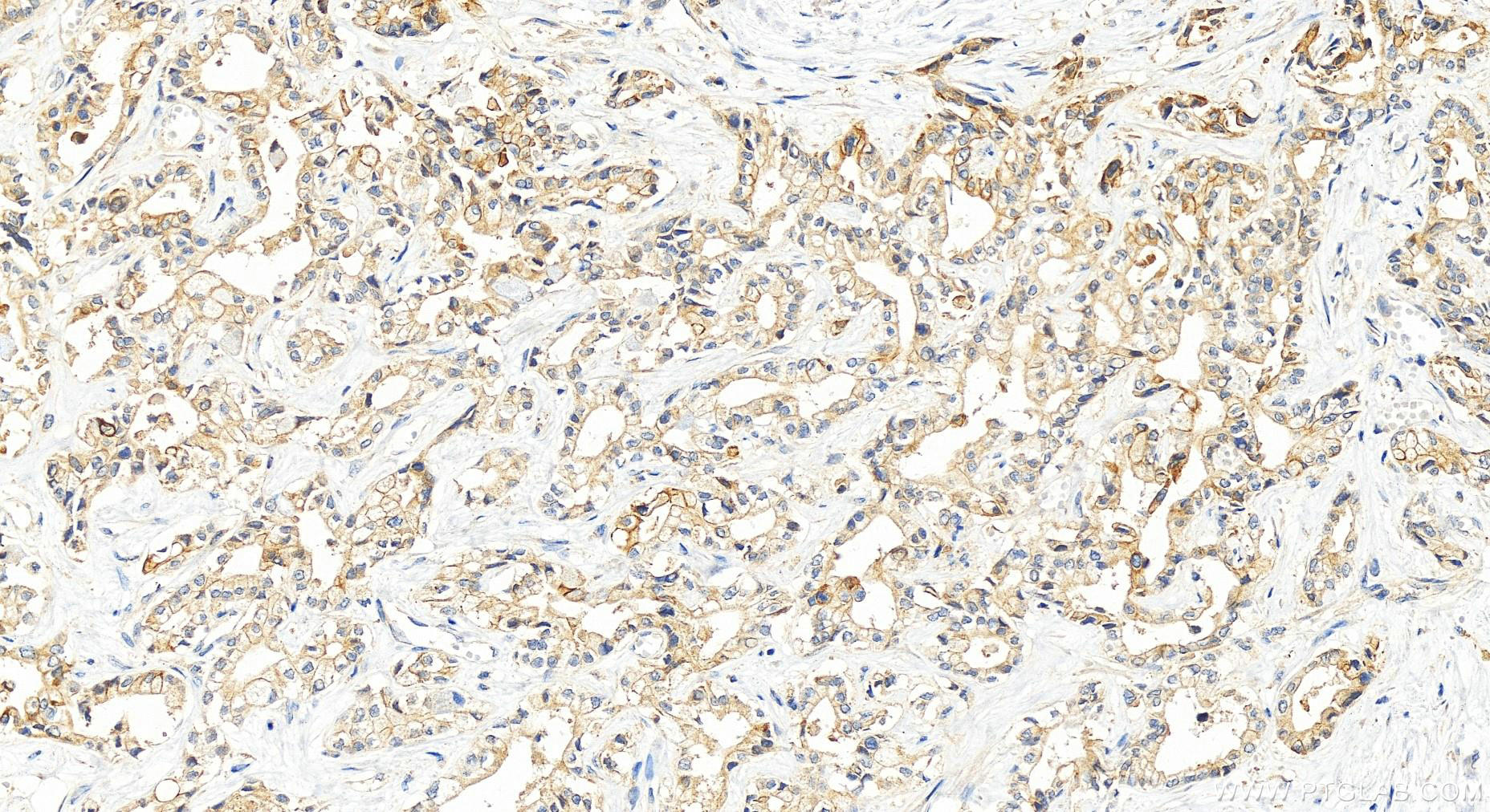 IHC staining of human intrahepatic cholangiocarcinoma using 10878-1-AP