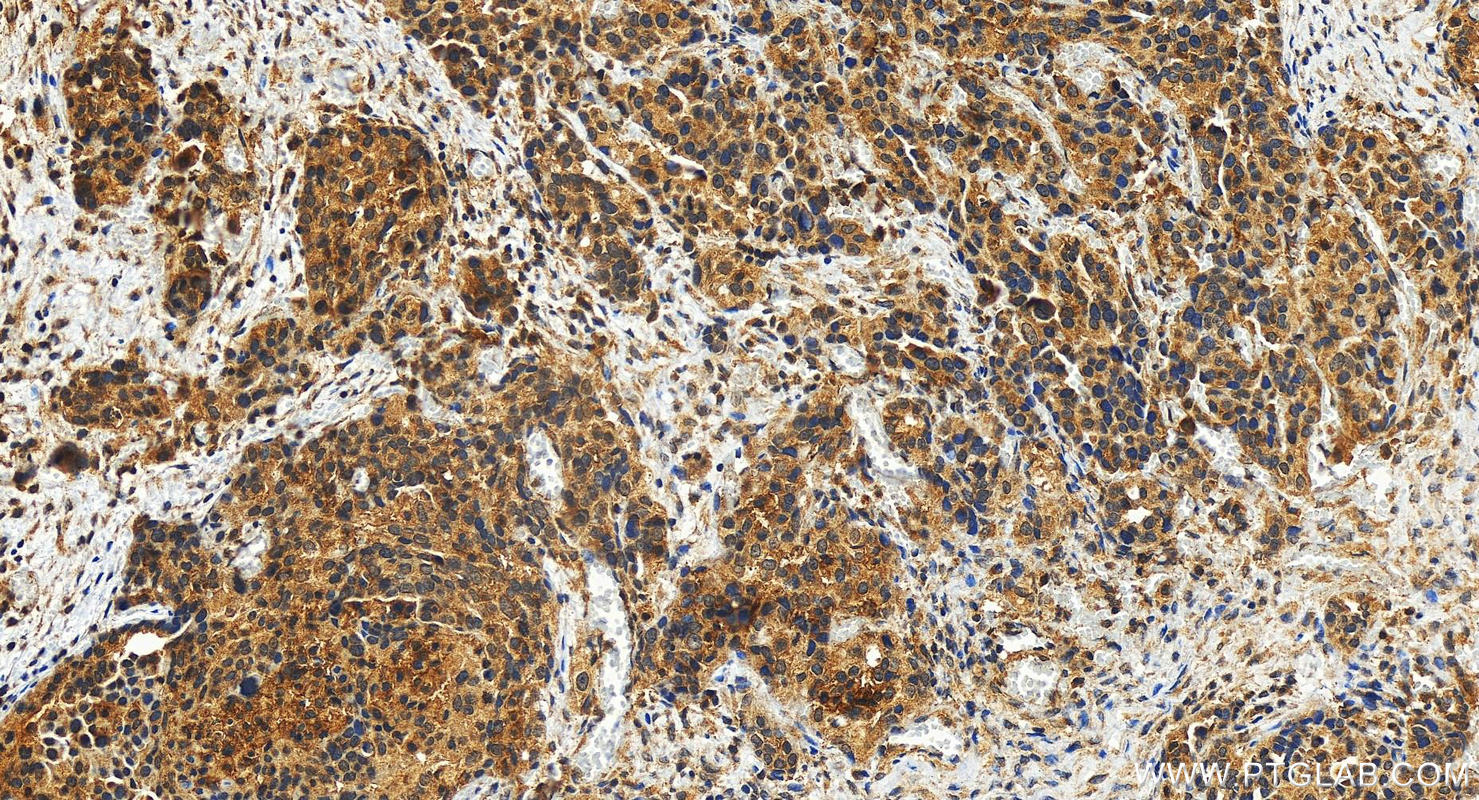 IHC staining of human ovary cancer using 10878-1-AP