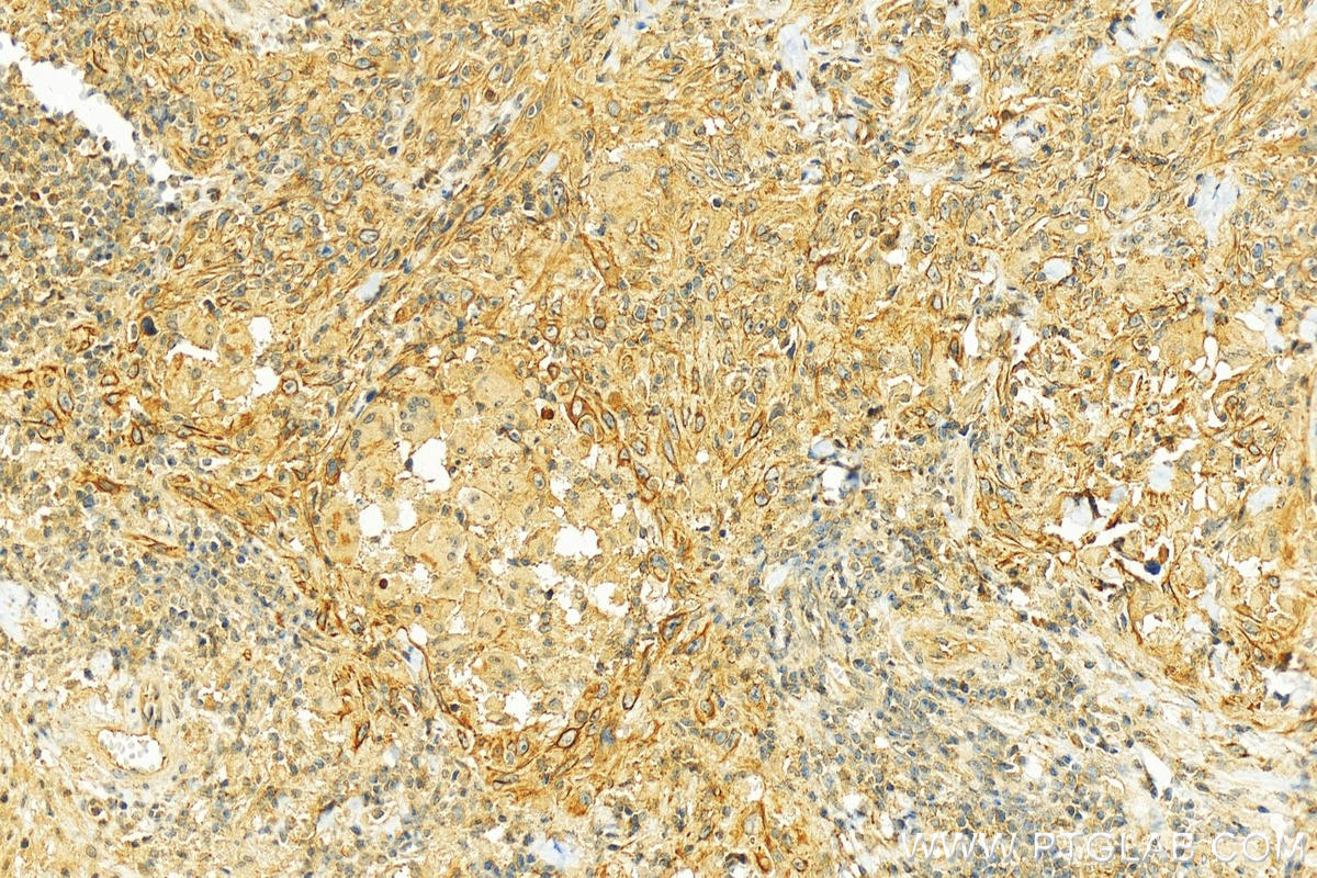 IHC staining of human skin cancer using 10878-1-AP