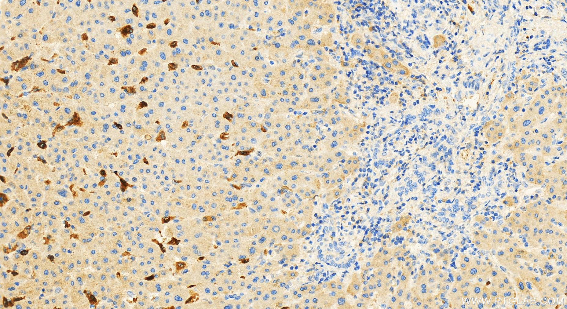 IHC staining of human intrahepatic cholangiocarcinoma using 17224-1-AP