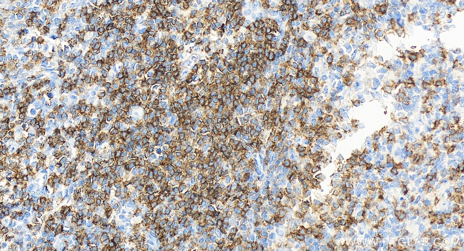 IHC staining of human tonsillitis using 84508-5-RR (same clone as 84508-5-PBS)