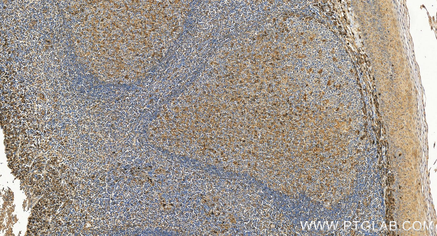 IHC staining of human tonsillitis using 25682-1-AP