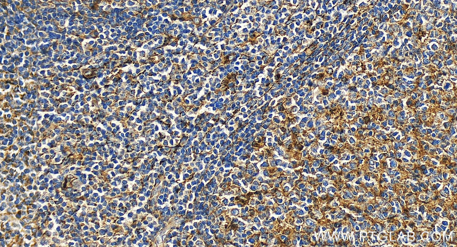 IHC staining of human tonsillitis using 25682-1-AP