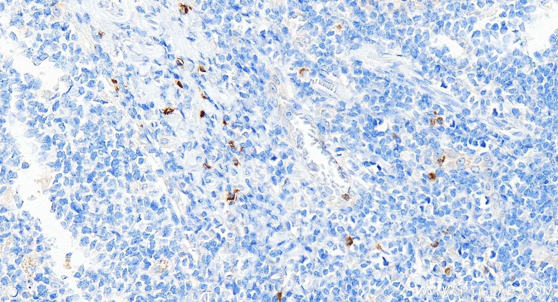 IHC staining of human tonsillitis using 84507-4-RR (same clone as 84507-4-PBS)