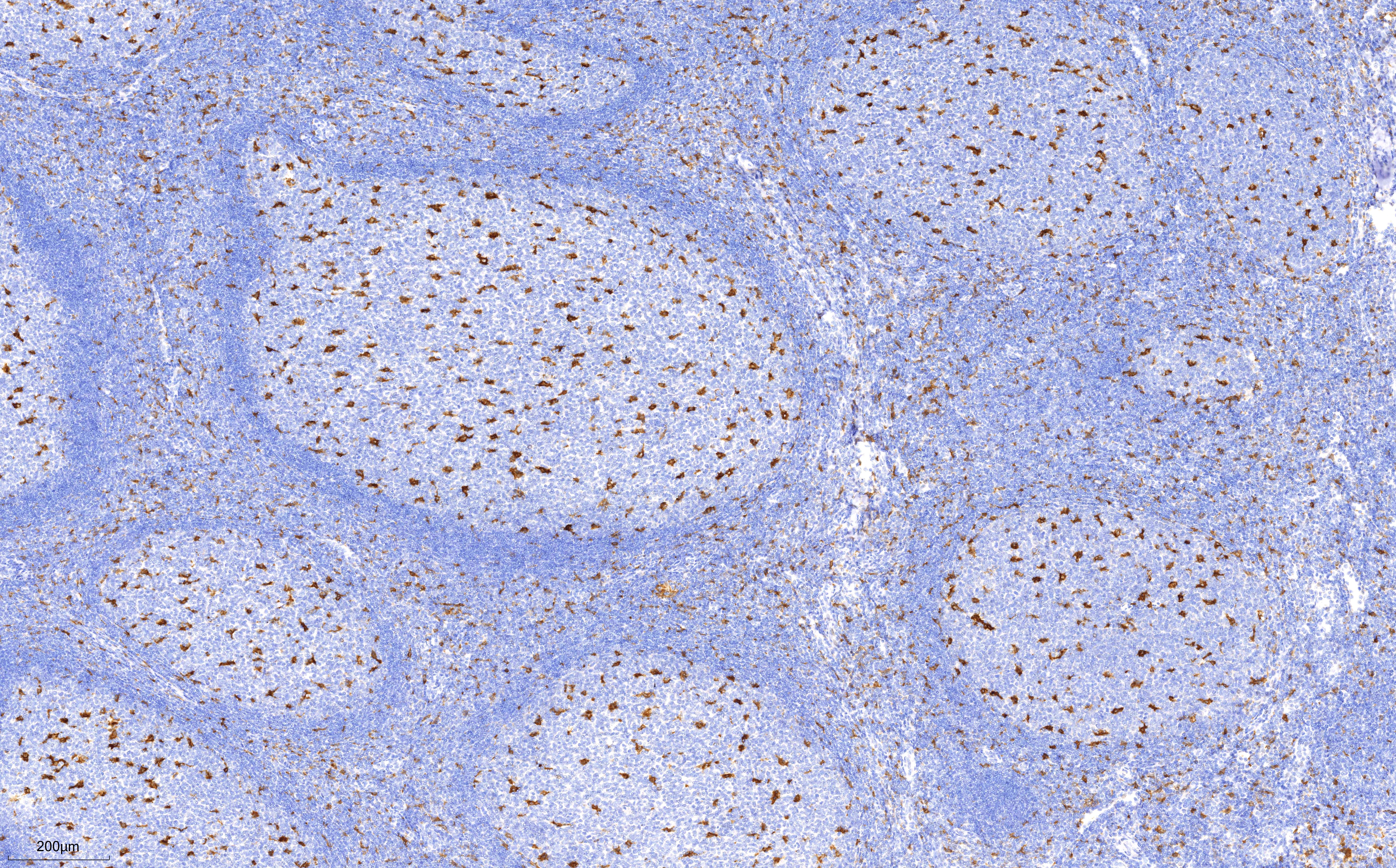 IHC staining of human tonsillitis using 66231-2-Ig