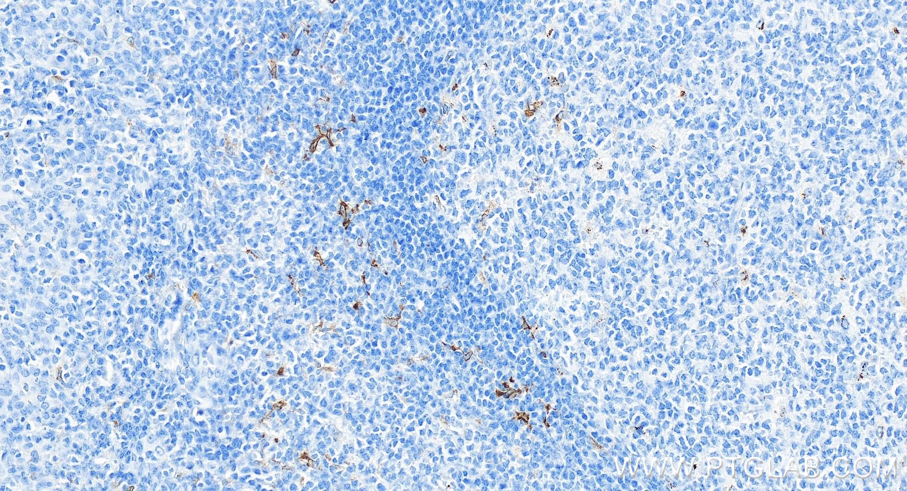 IHC staining of human tonsillitis using 84596-4-RR