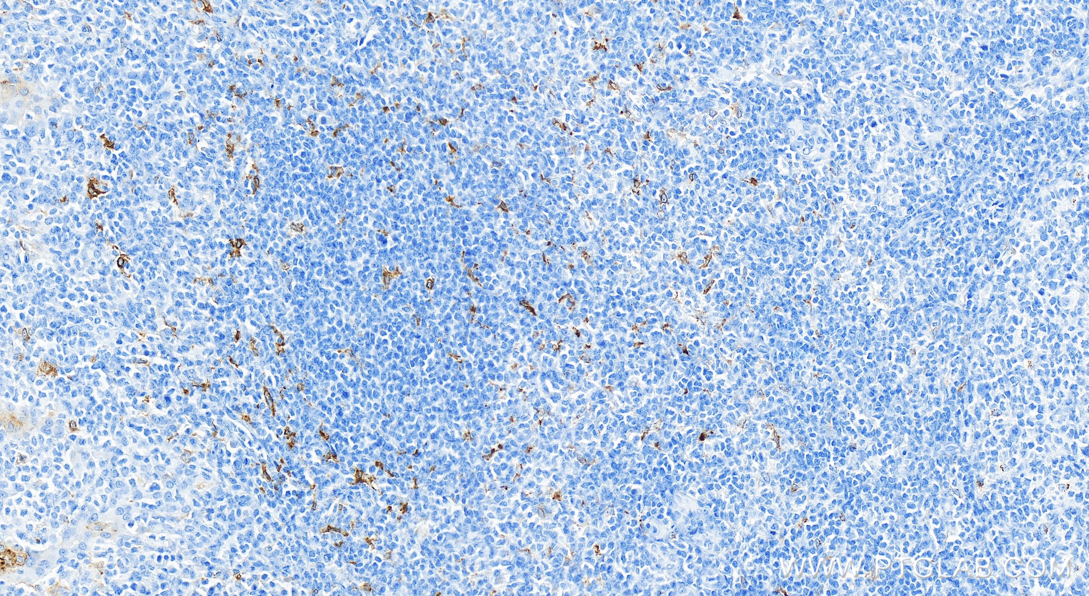 IHC staining of human tonsillitis using 84596-4-RR