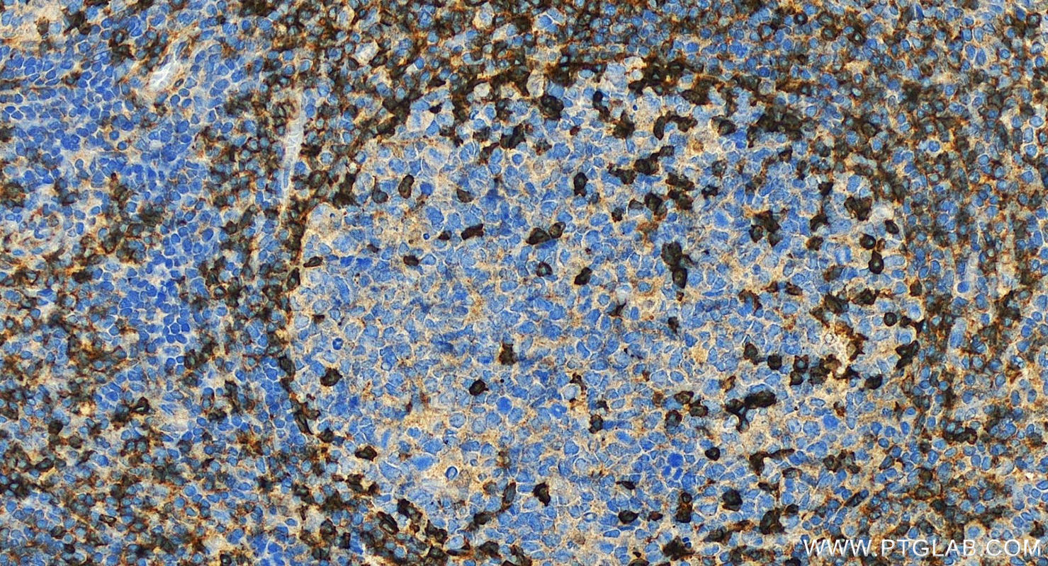 IHC staining of human tonsillitis using 10803-1-AP