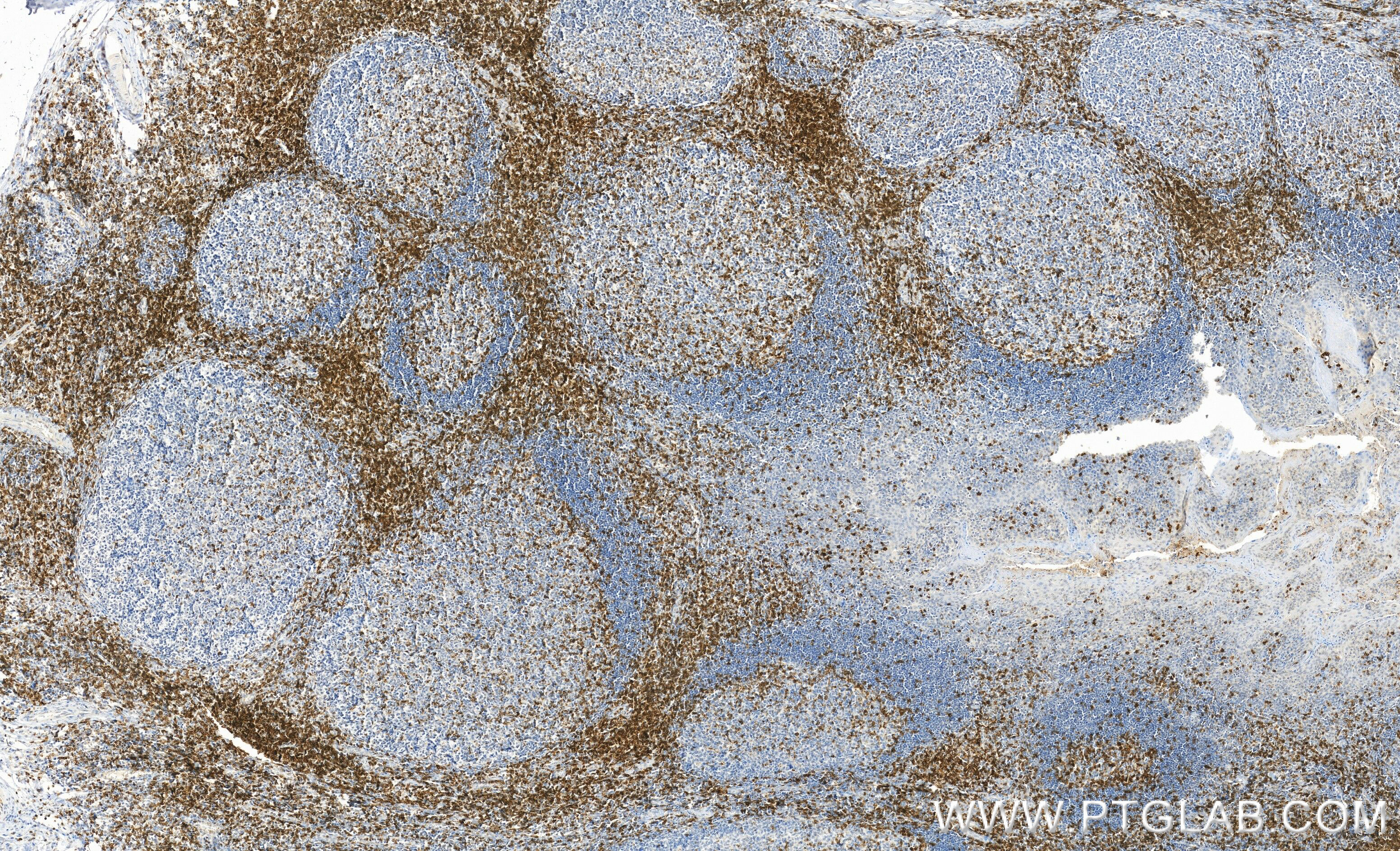 IHC staining of human tonsillitis using 60209-2-Ig