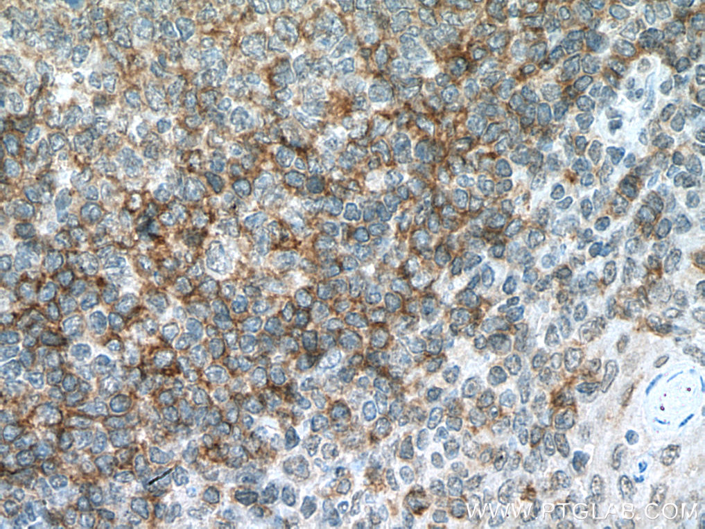 IHC staining of human tonsillitis using 67424-1-Ig (same clone as 67424-1-PBS)