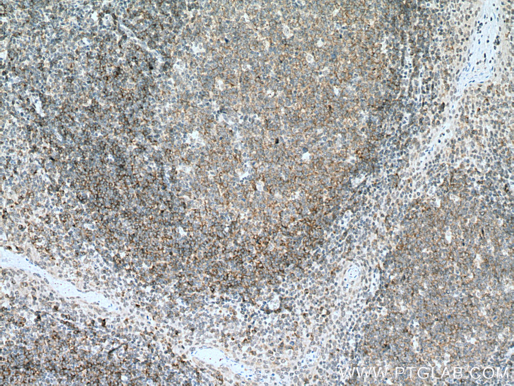 IHC staining of human tonsillitis using 67424-1-Ig