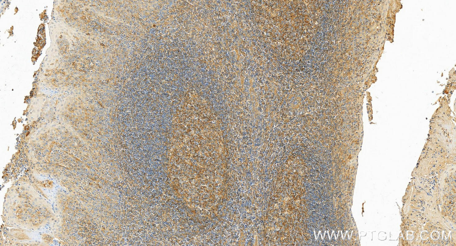 IHC staining of human tonsillitis using 27855-1-AP