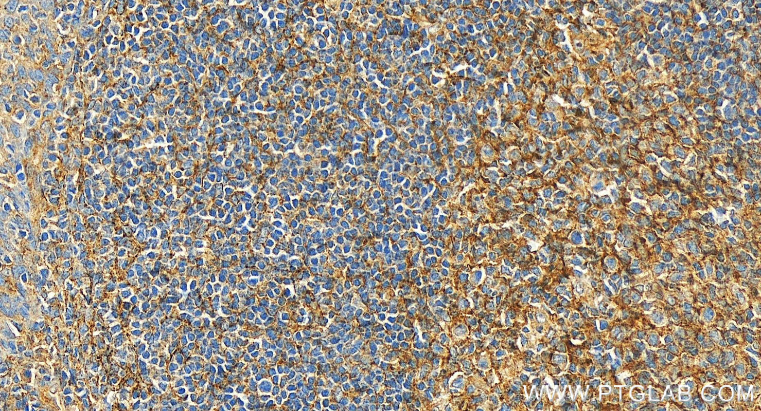 IHC staining of human tonsillitis using 27855-1-AP