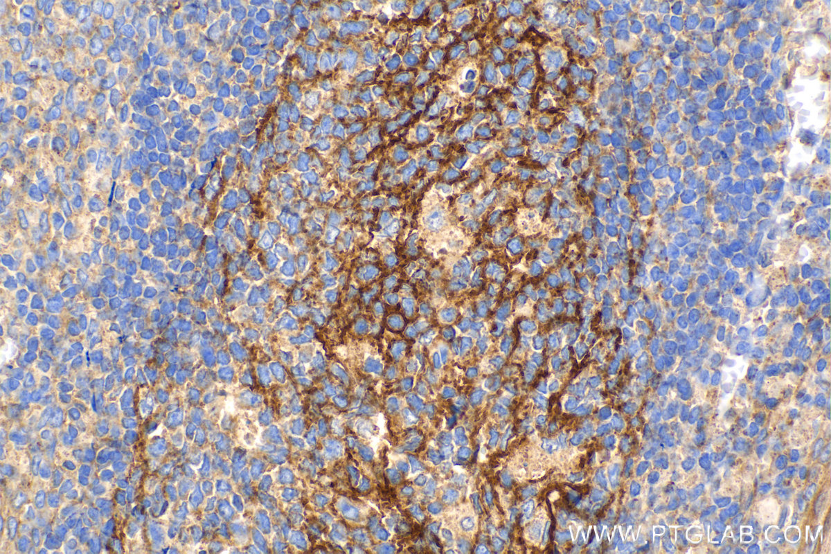 IHC staining of human tonsillitis using 66803-1-Ig (same clone as 66803-1-PBS)