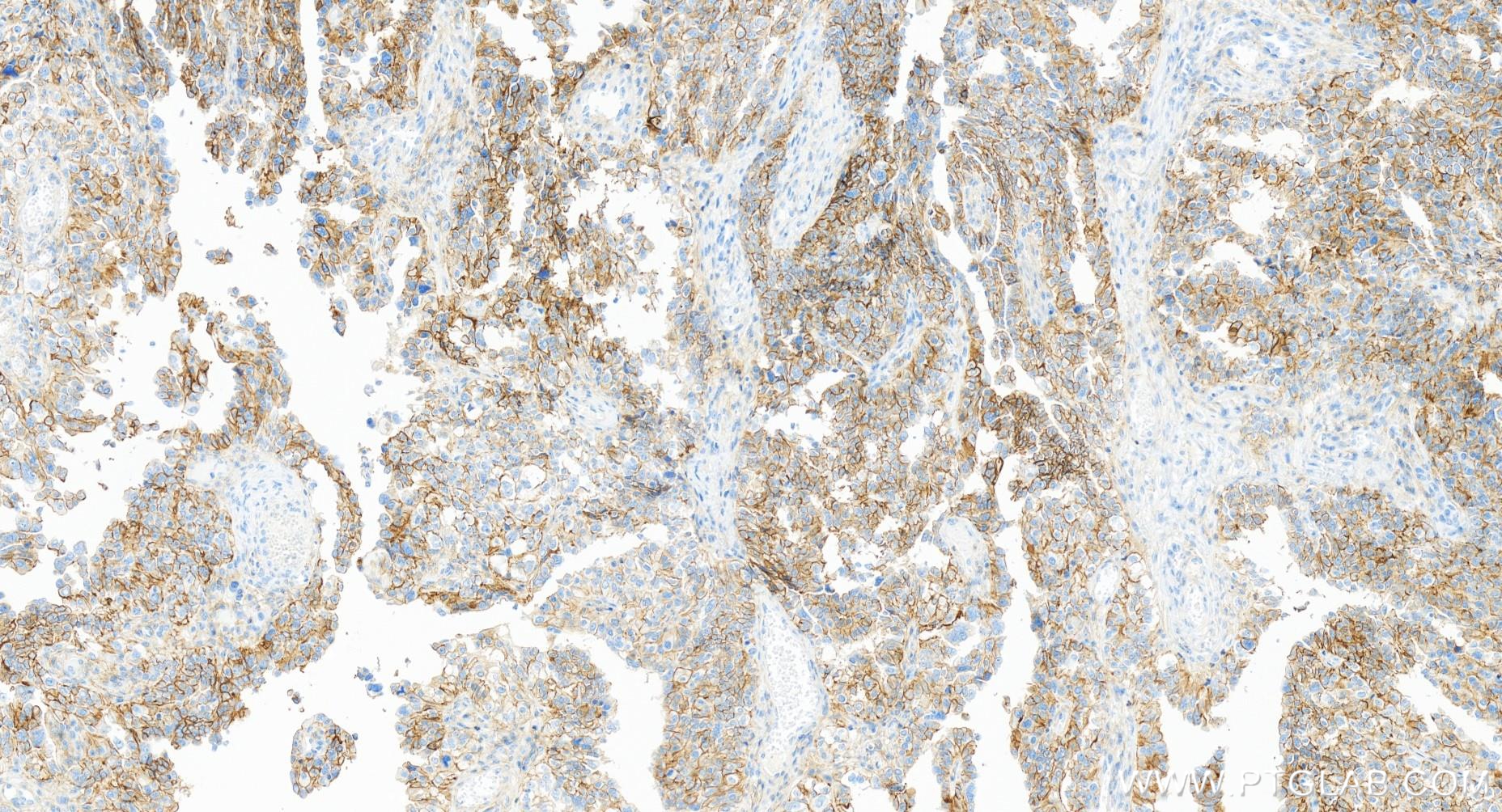 IHC staining of human ovary cancer using 84617-7-RR (same clone as 84617-7-PBS)