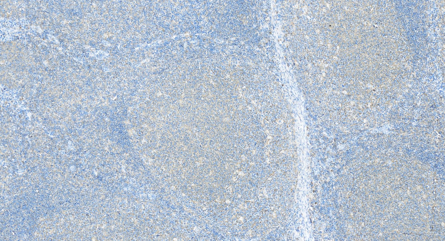 IHC staining of human tonsillitis using 84617-7-RR (same clone as 84617-7-PBS)